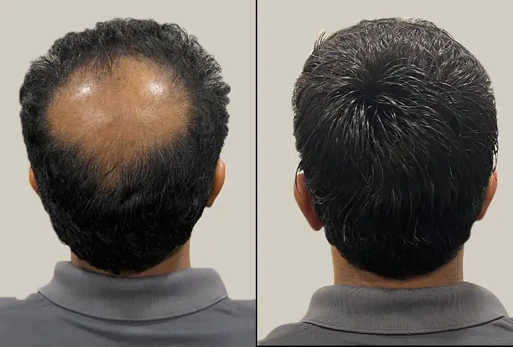 FUE Crown Coverage Result